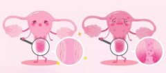 卵巢早衰有哪几种征兆，月经失调/精神不振/泌尿系统疾病